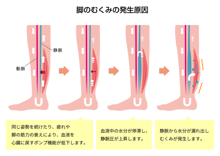 足のむくみの原因